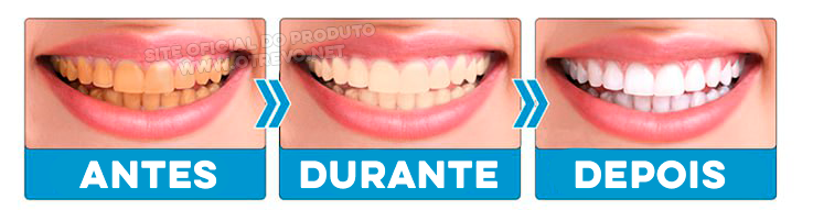 Clareador Dental - ®V34 (Clareamento instantâneo)