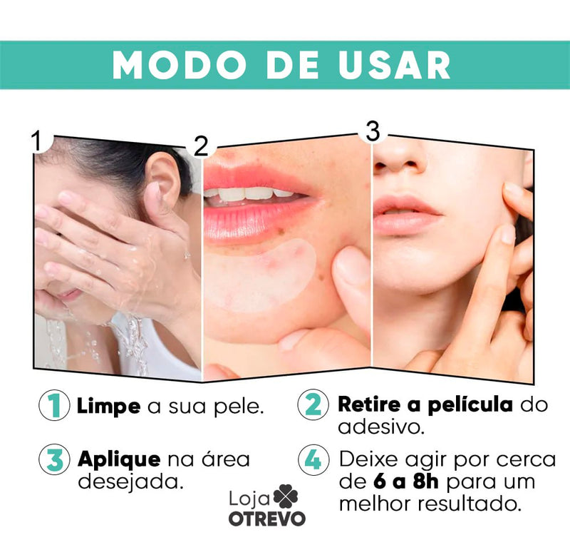 Adesivos Hidrocoloide Secadores e Removedores de Espinhas - AcneControl®